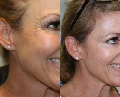 Botox before and after photo