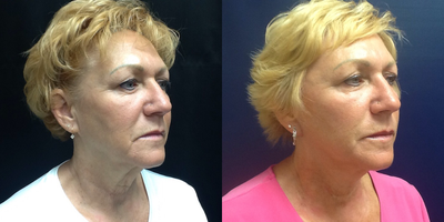Cheek Lift before and after photo