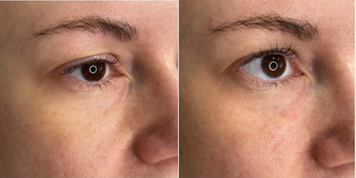 Dermal Fillers before and after photo