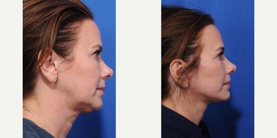 Facelift before and after photo