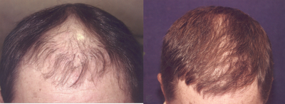 Hair Transplant before and after photo