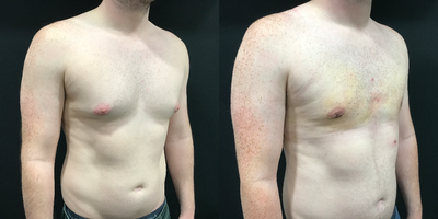Tumescent Liposuction before and after photo