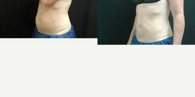 CoolSculpting before and after photo