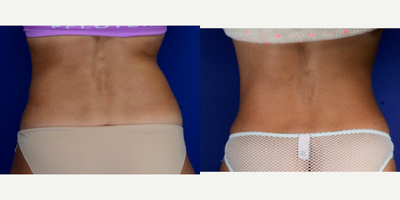 CoolSculpting before and after photo