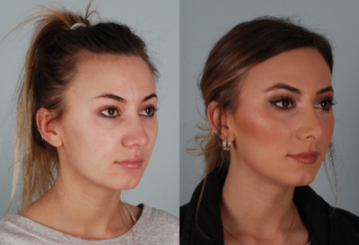 Rhinoplasty before and after photo