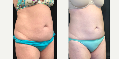 CoolSculpting before and after photo