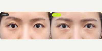 Double Eyelid Surgery before and after photo
