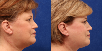 Facelift before and after photo
