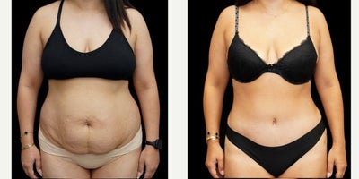Tummy Tuck before and after photo