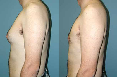 Breast Reduction before and after photo