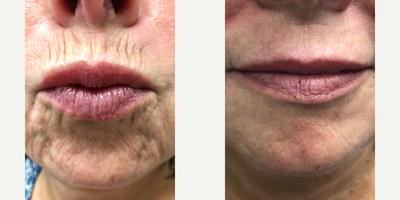 Dermal Fillers before and after photo