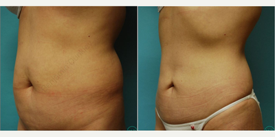 Liposculpture before and after photo