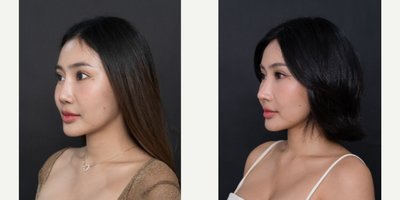 Rhinoplasty before and after photo