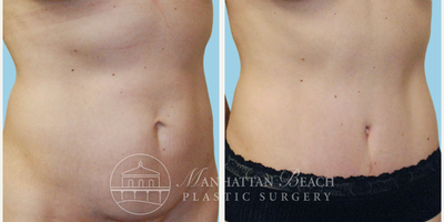 Tummy Tuck before and after photo
