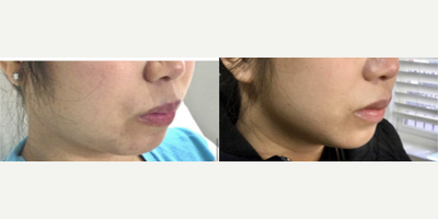 Ultherapy before and after photo