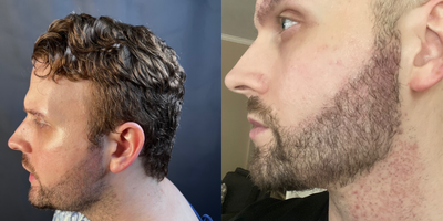 Beard Transplant before and after photo