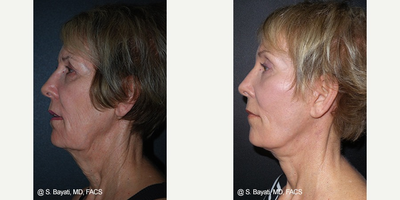 Facelift before and after photo