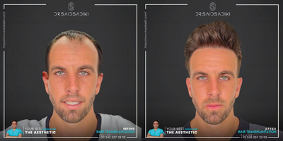 FUE Hair Transplant before and after photo