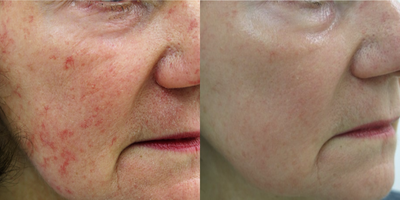 Skin Rejuvenation before and after photo