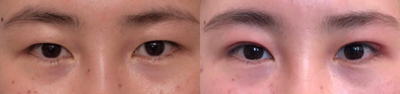 Double Eyelid Surgery before and after photo
