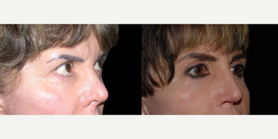 Eyelid Surgery before and after photo