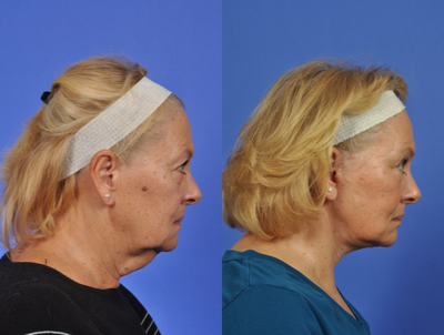 Facelift before and after photo