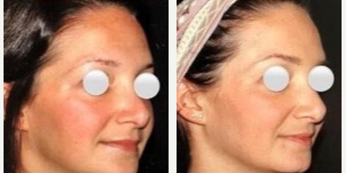 Halo Laser before and after photo