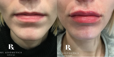 Restylane Refyne before and after photo