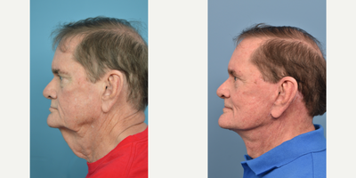 Cheek Lift before and after photo