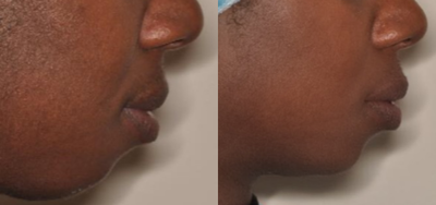 Chin Filler before and after photo