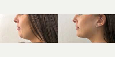 Chin Filler before and after photo