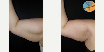 Exilis before and after photo