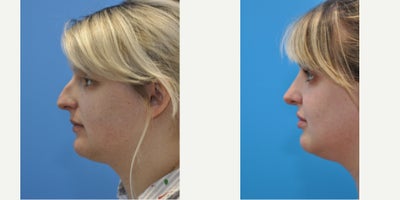 Rhinoplasty before and after photo