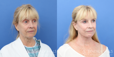 Brow Lift before and after photo