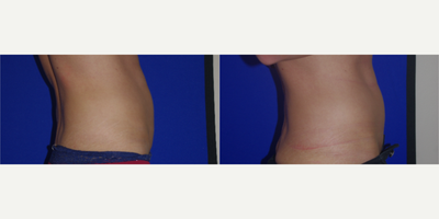 CoolSculpting before and after photo