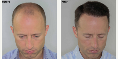 Hair Transplant before and after photo