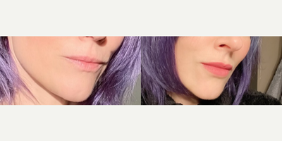 Juvederm before and after photo