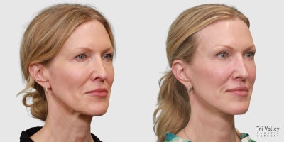 Lip Lift before and after photo
