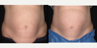 CoolSculpting before and after photo