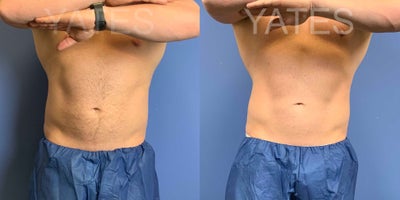 CoolSculpting before and after photo