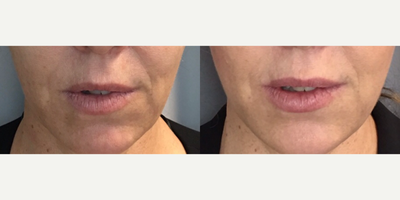 Dermal Fillers before and after photo