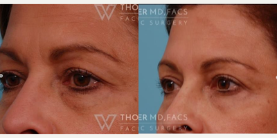 Eyelid Surgery before and after photo