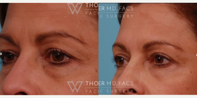 Eyelid Surgery before and after photo
