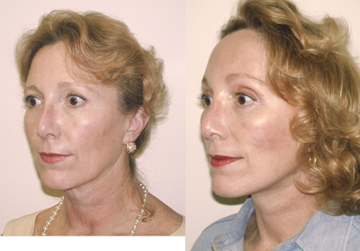 Facelift before and after photo