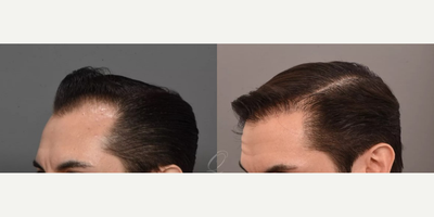 Hair Transplant before and after photo