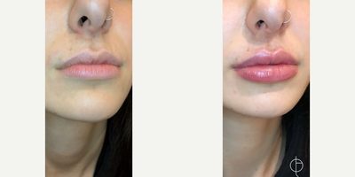 Lip Fillers before and after photo
