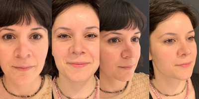 Revision Rhinoplasty before and after photo