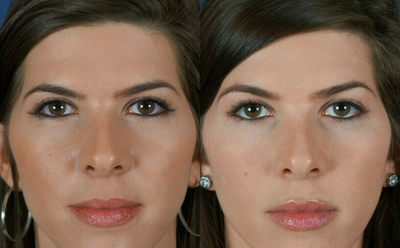 Botox before and after photo