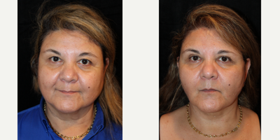 Buccal Fat Removal before and after photo
