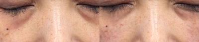 Dermal Fillers before and after photo